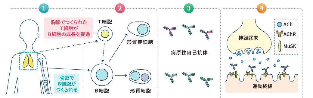 全身型MGのさまざまな治療法